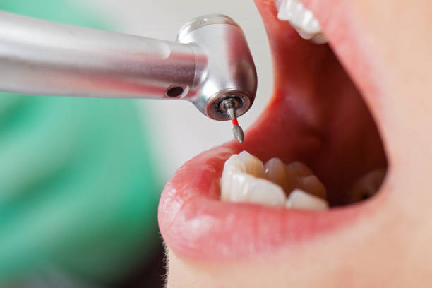 Best Emergency Tooth Extraction in White River Junction, VT
